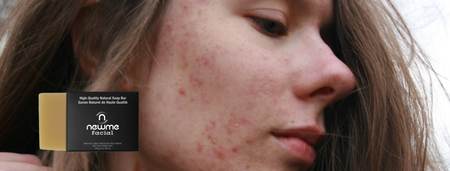 Four Simple Things You Can Do to Stop the Forming of Acne in Your Face